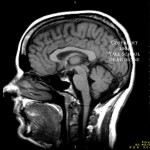 mri-brain